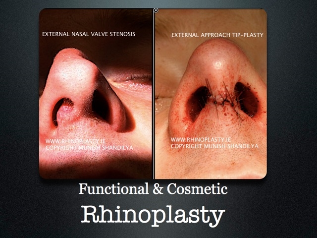 rhinoplasty doctor